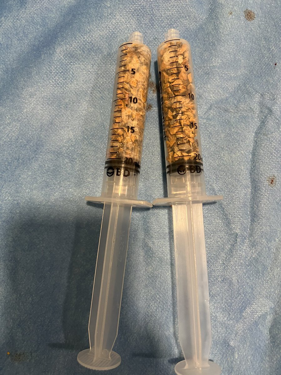 drvicenterivera's tweet image. Una piedrita renal sabatina! @Santiago_AveBas @PulidoUro #Stonefree #Xrayfree #Ultrasoundrenalpuncture