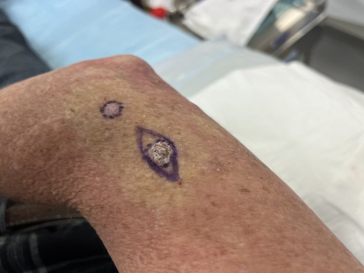 Snuff_Smith's tweet photo. Wear your sunscreen tweeps, wish I had of my first 30 years. https://t.co/Ri92Ddm8oT