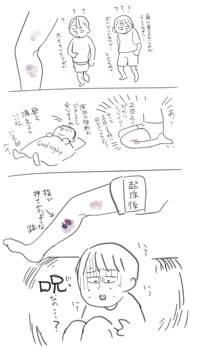 身に覚えのない痣ができるとすぐに呪を疑う日記 