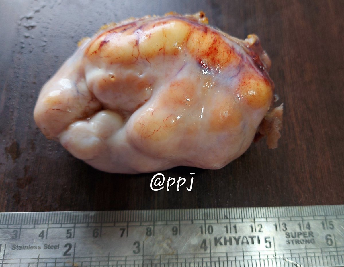 What do you think #PathTwitter ? 
#gynpath  
Elderly ♀️
Asymptotic mass
#pathclassic