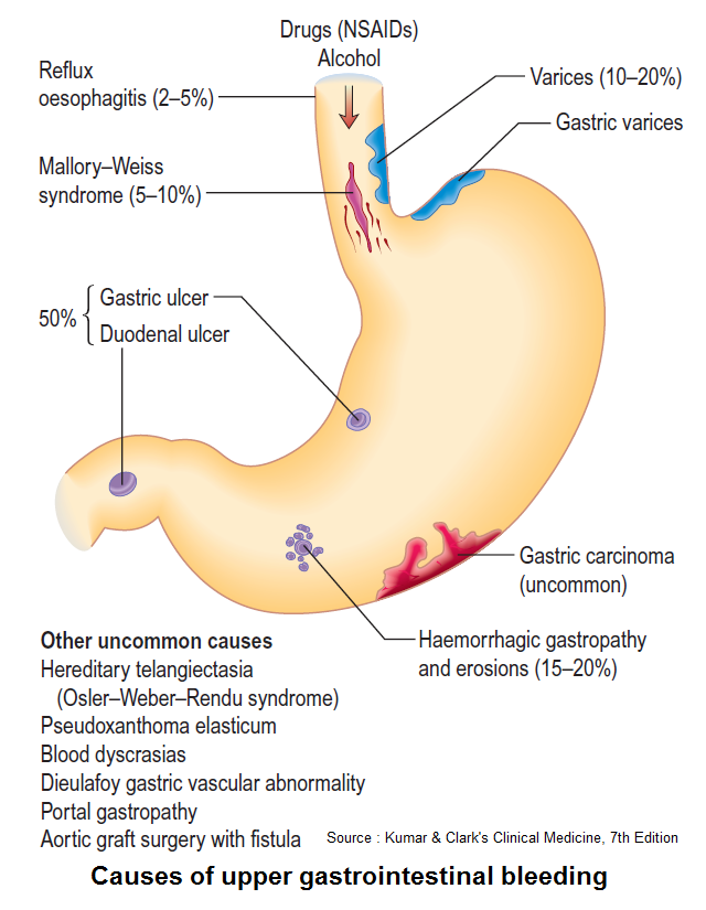 InnovGastro's tweet photo. Causes of Upper GI bleed and Approach
#medtwitter #foamed #meded #usmle  #GITwitter #GIPath #gastroenterology #GI #health #HealthyFood  Credit @MatthewHoMD https://t.co/dKAbHrvZUs