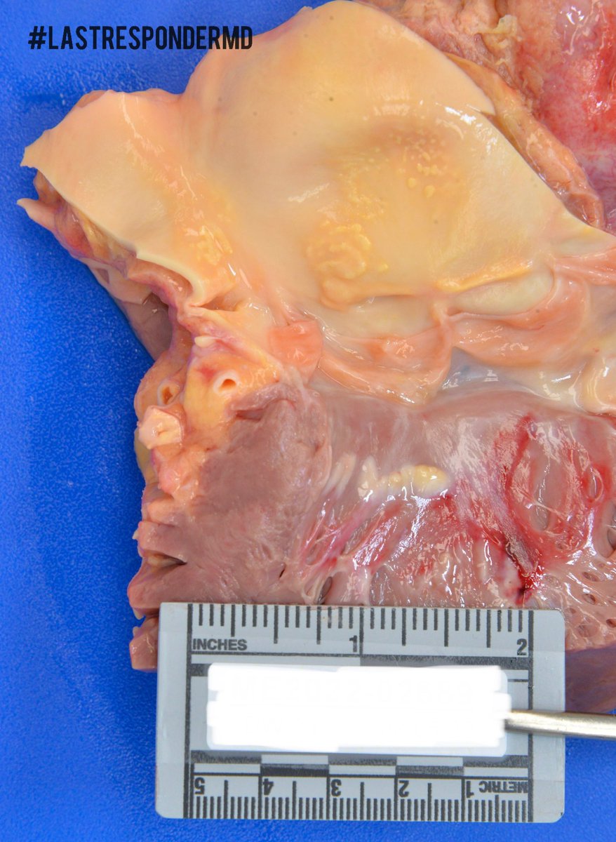 MdResponder's tweet photo. Incidental finding during in an autopsy of a young male. Any res/student want to comment on the gross appearance of the heart and what we should be concerned about? #4n6 #Cardiotwitter https://t.co/nRHARR0OIH