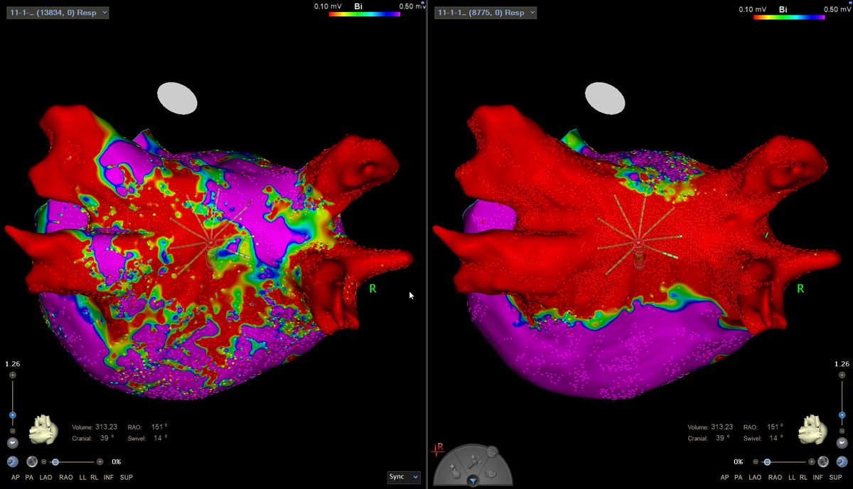 First use of Octaray for me at GMC - persistent AF, LA volume 300 ml, PVI/CTI, posterior box, targeted GP ablation 

Ty for the opportunity <a href="/BeebePhD/">Tyler Beebe</a>