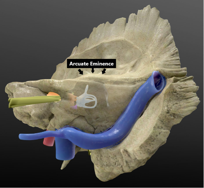 neurosurgatlas's tweet photo. The arcuate eminence (AE) is a bony ridge identified on the floor of the middle fossa. Historically, it was acknowledged as a landmark for the superior semicircular canal. Recent studies show that the AE is not a reliable landmark for localizing the SSC. 

#MedTwitter #NSGY https://t.co/azzcoqCzoU