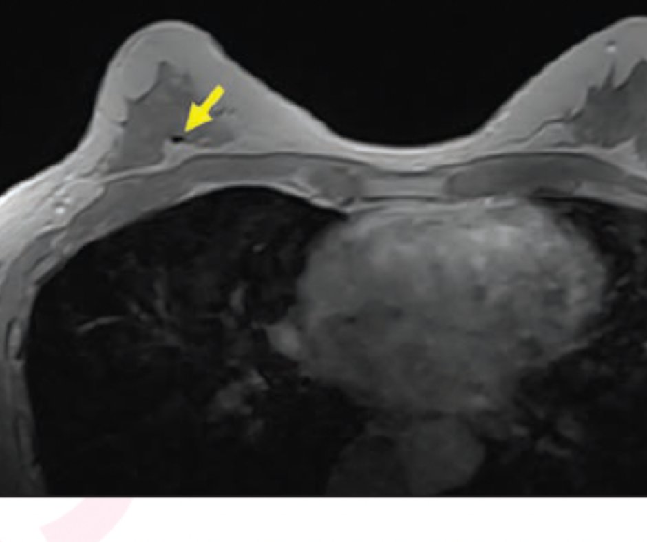Diagnostic Imaging on Twitter "Locating Biopsy Marker Clips on 