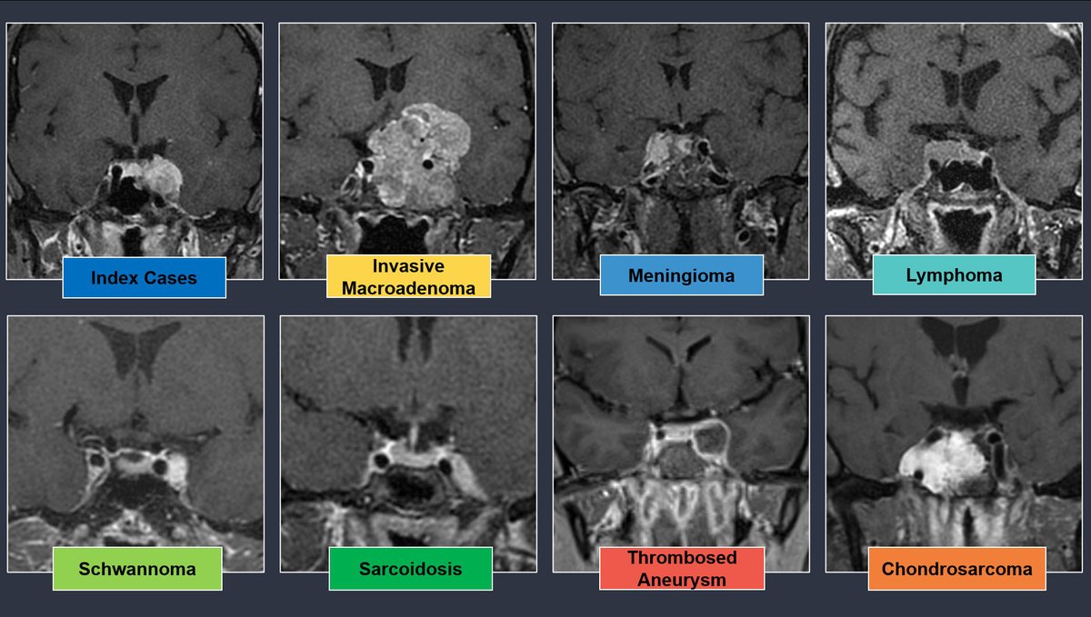 When constructing a differential diagnosis for lesions within the cavernous sinus think about lesions associated with cranial nerves and vessels. Don’t forget to include tumors that extend from the sella, adjacent meninges and skull base. #CNC22 @TheASNR
