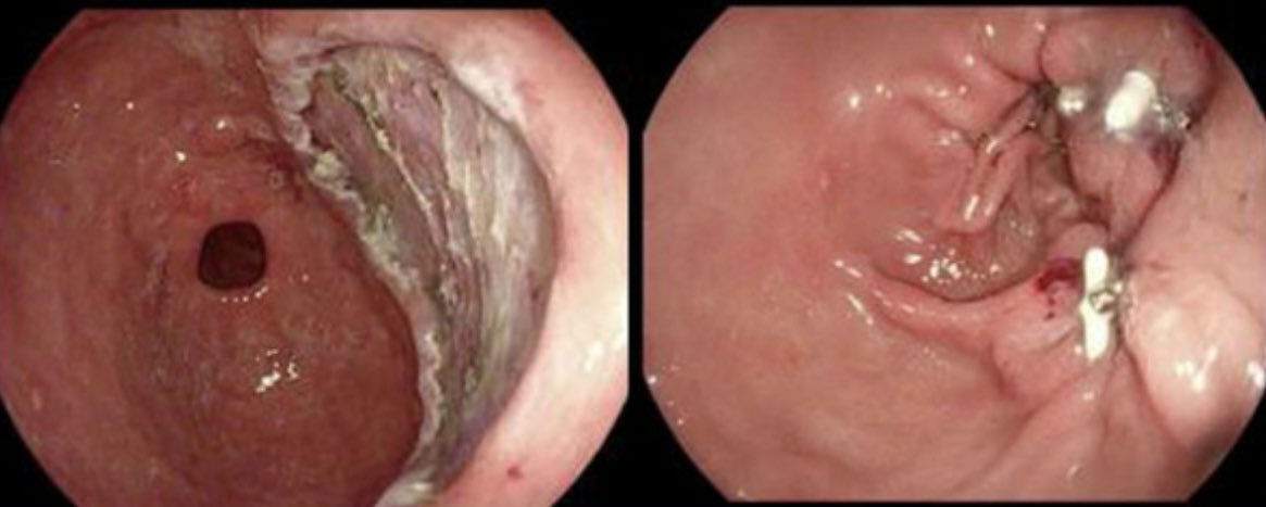 TaraKeihanian MD. MPH. (@keihaniantara) on Twitter photo Through-the-scope suturing (X-tack) is an ideal option for tissue approximation of large resection beds post EMR and ESD within the right side of the colon and areas with limited space for maneuverability.
authors.elsevier.com/sd/article/S24…
<a href="/EndoscopyOthman/">Mohamed Othman</a> <a href="/GiJawaid/">Salmaan Jawaid, MD</a> <a href="/bcm_gihep/">BCM Gastroenterology</a> Through-the-scope suturing (X-tack) is an ideal option for tissue approximation of large resection beds post EMR and ESD within the right side of the colon and areas with limited space for maneuverability.
authors.elsevier.com/sd/article/S24…
<a href="/EndoscopyOthman/">Mohamed Othman</a> <a href="/GiJawaid/">Salmaan Jawaid, MD</a> <a href="/bcm_gihep/">BCM Gastroenterology</a>