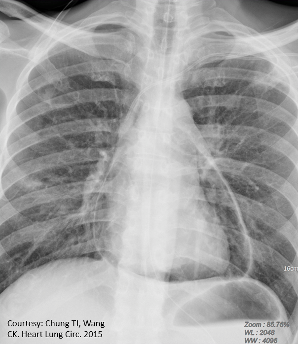 NephroP's tweet photo. Diagnosis?
#xray #MedEd https://t.co/tlA9loqRIB