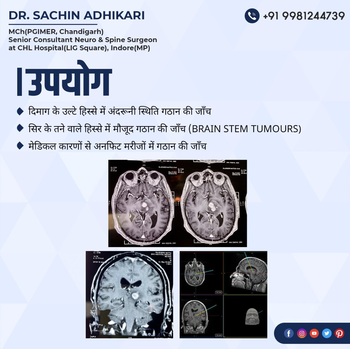 SACHINA40585950's tweet photo. नेवीगेशन गाइडेड बायोप्सी से ब्रेन में जो बहुत डीप सिटर ट्यूमर है, या ब्रेन स्टेम के जो ट्यूमर है #CHLHospital #Navigationguidedbiopsy #drsachinadhikari #biopsy #brainbiopsy #brainissue #tumor #tumorbiopsy #imageguided #neurosurgeon #seniorconsultant #braintumor #braintumoraware https://t.co/98xdiPvLiw