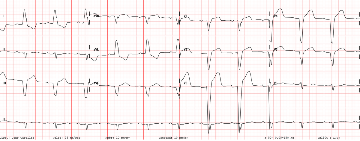 carprimur's tweet photo. ♂️ 55 años asintomático con ECG anormal en reconocimiento de empresa. https://t.co/E2kgNNoNXp