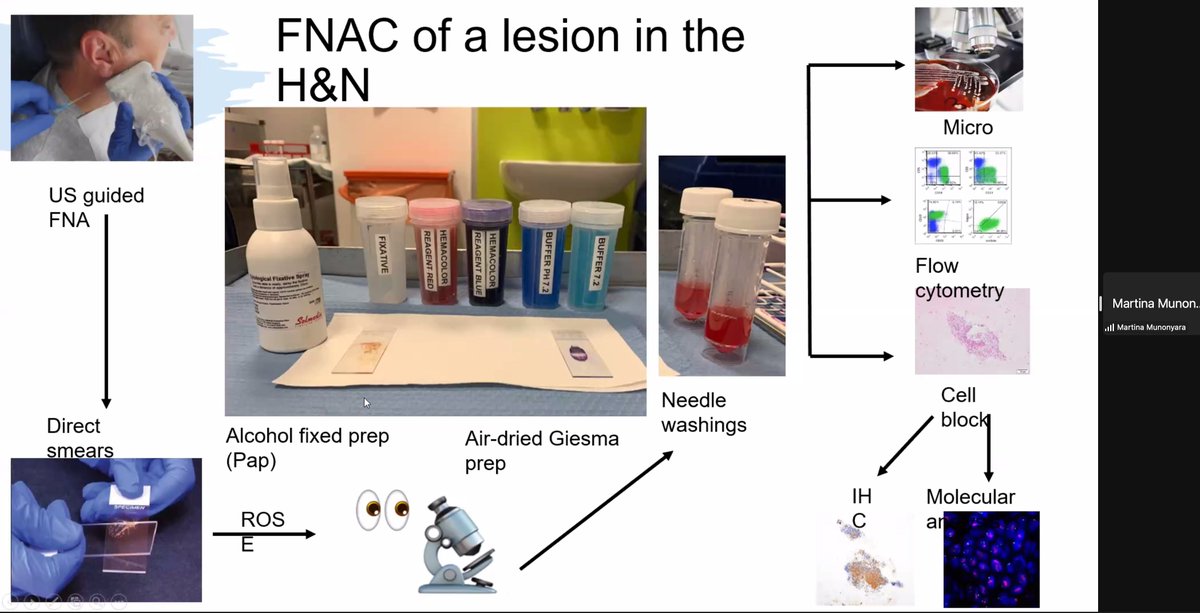 AshishC97225686's tweet photo. Triage of HN FNA ROSE samples. Martina Munonyara @britishcytology https://t.co/QXenyP60oS