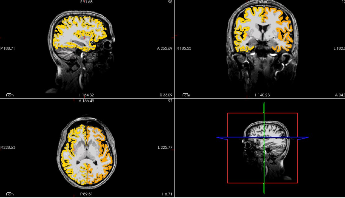 thomcat992's tweet photo. OK, first to admit I was wrong.
#FastSurfer cortical thickness estimation of 7T data of a patient with #MND. A game changer in a fraction of the time. #neuroscience #ALS #MRI https://t.co/yB3n8R4z2f