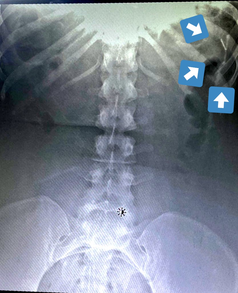 Jose_AngelCI's tweet photo. Cosas que no creí que llegaría a ver en la medicina... Un DIU en abdomen. Andaba tocando la puerta para pasar a pulmón 🤣. https://t.co/UZOGhzzjVZ