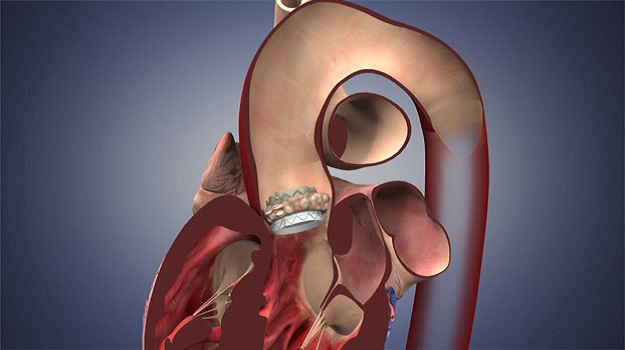 American College of Cardiology (@accintouch) on Twitter photo The PROTECTED TAVR trial showed that routine use of a CEP device does not result in a lower risk of #stroke within 72 hours among patients undergoing transfemoral #TAVR for #vhdAS. Find out more: bit.ly/3xvPsiL #TCT2022 <a href="/DLBHATTMD/">Dr. Deepak L. Bhatt</a> The PROTECTED TAVR trial showed that routine use of a CEP device does not result in a lower risk of #stroke within 72 hours among patients undergoing transfemoral #TAVR for #vhdAS. Find out more: bit.ly/3xvPsiL #TCT2022 <a href="/DLBHATTMD/">Dr. Deepak L. Bhatt</a>