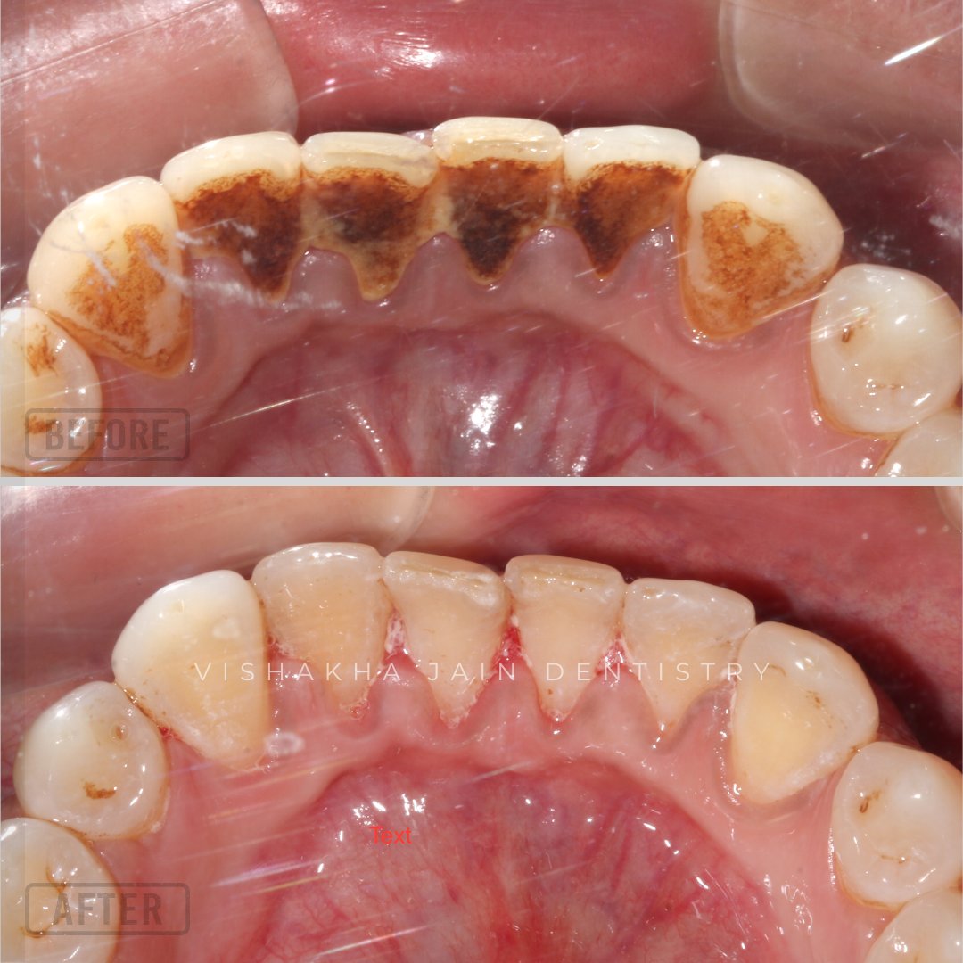 ClinicIndore's tweet photo. Teeth Cleaning! 
Visit the Seraphic Dental clinic Indore for the most advanced, painless, and efficient services with one day procedure!

Visit- https://t.co/A5w4bup5MD

Book appointment- +91 9009388502

#teethwhitening  #digitaldentistry #smile #smiledesign #seraphicdental https://t.co/yxGEI8a5KN