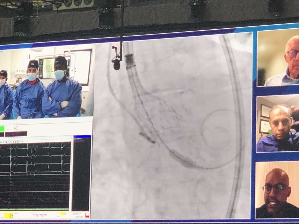 ZeroTLR's tweet photo. First live case ( not live 😑) with @didier_tchetche structural theater
#cuspoverlap #TAVR #TCT2022 https://t.co/3JYsMAuC99