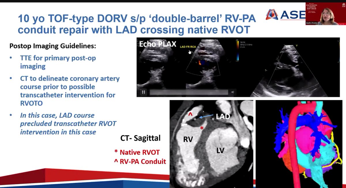 DrJenniferCo_Vu's tweet photo. Channel 2 @ASE360 Inaugural Echo in Pediatric &amp; Congenital Heart Disease Virtual Experience is now working! #ASEPCHD22
Go to the ASE Learning Hub and click launch now!
@MelisWasserman @bifflandeck @daniel_forsha @ShelbyKuttyMD @craigefleishman @Jimmy_C_Lu @anudodejamd @SOPedsEcho https://t.co/vSYN6BVjBQ