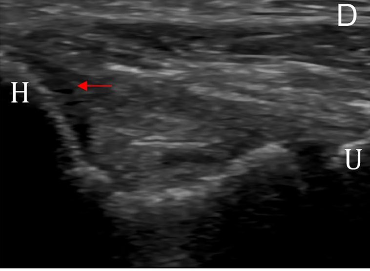 LoriMichener's tweet photo. US images of both medial elbows college ⚾️pitchers by @CoorLab_USC:
⬆️UCL thickening
⬆️UCL degeneration &amp; enthesopathy 
⬆️UH joint gapping
▶️Degenerative UCL changes predict UH jt gapping
▶️Enthesopathy &amp; calcifications predict UCL thickening
https://t.co/KsEGXTk70p
@Lobbster93 https://t.co/gK6DItzTxA
