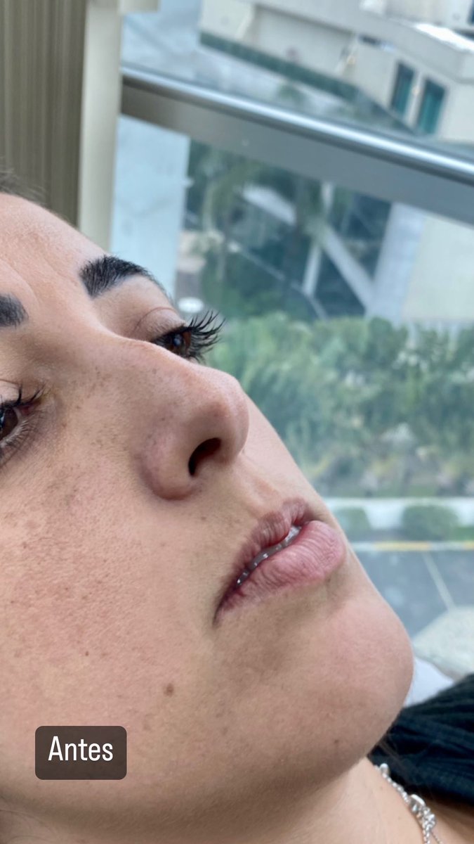 RaiRibeiiro's tweet image. Um antes e depois que até @gessicakayane respeita haha #harmonizacaofacial é devolver formas #preenchimentolabial