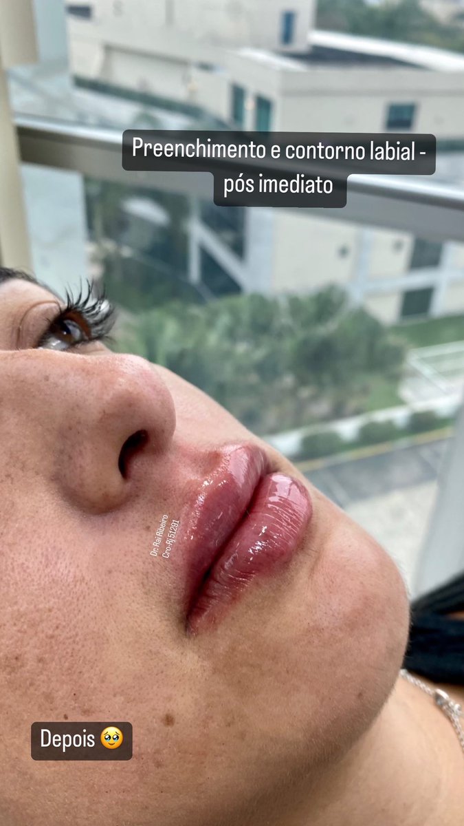 RaiRibeiiro's tweet image. Um antes e depois que até @gessicakayane respeita haha #harmonizacaofacial é devolver formas #preenchimentolabial