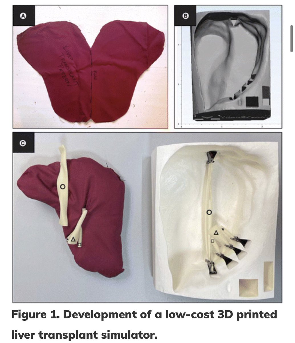Itai Palmon (@ipalmon) on Twitter photo The landscape for surgical training is evolving with increasing accessibility of low-cost methods! 3D printing is a great way to develop high fidelity simulators to improve trainee readiness for operations. Check out our recent work
futuremedicine.com/doi/10.2217/3d… <a href="/UM_TREE/">UM Transplant Research Education and Engagement</a> The landscape for surgical training is evolving with increasing accessibility of low-cost methods! 3D printing is a great way to develop high fidelity simulators to improve trainee readiness for operations. Check out our recent work
futuremedicine.com/doi/10.2217/3d… <a href="/UM_TREE/">UM Transplant Research Education and Engagement</a>