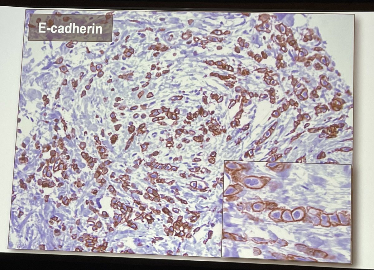 Dr. <a href="/SchnittStuart/">Stuart Schnitt</a> covering Updates on Lobular Carcinoma In Situ Classification and Management … WATCH OUT for invasive lobular carcinoma with aberrant e-Cadherin staining!