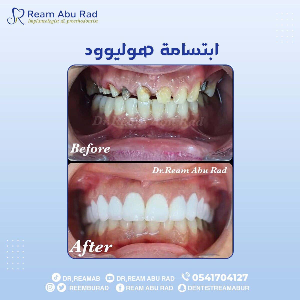 reemaburad's tweet photo. جمال ابتسامتك أكيد
مع ابتسامة المشاهير🤩👌🏻
.
.
.
#طب_اسنان #ابتسامة_المشاهير https://t.co/7N0JqoFGId