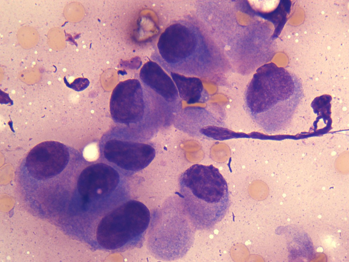 bfaquin's tweet photo. FNA of parotid mass in an elderly man: this shows characteristic cytologic features of salivary duct carcinoma. IHC for androgen receptor can be used to confirm the dx. https://t.co/c690WK4gR0