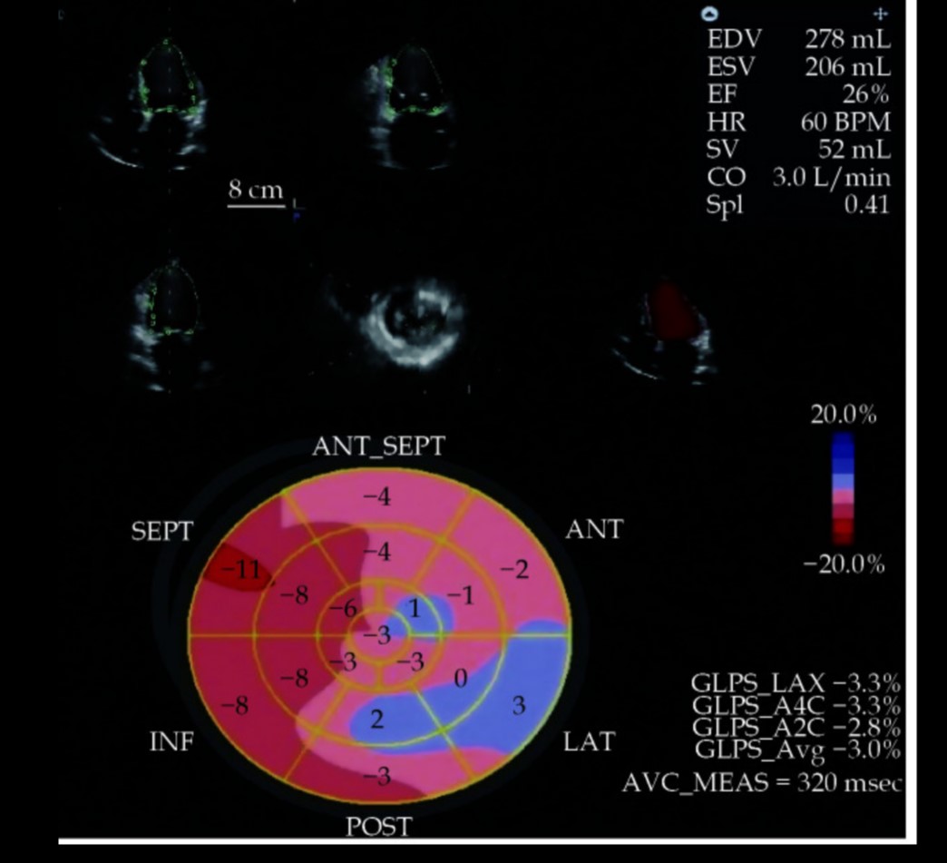 Egocardio's tweet photo. Slow LEVOSIMENDAN 💉, worth it?  TL;DR Yes!

How? In our study, we evaluate GLS, 3D echo, and impedance ECG modifications during levosimendan infusion.

10.11909/j.issn.1671-5411.2021.12.010
#Cardiology #echofirst #advancedimaging #Cardiotwitter #echocardiography #criticalcare https://t.co/hnc4sHaRP7