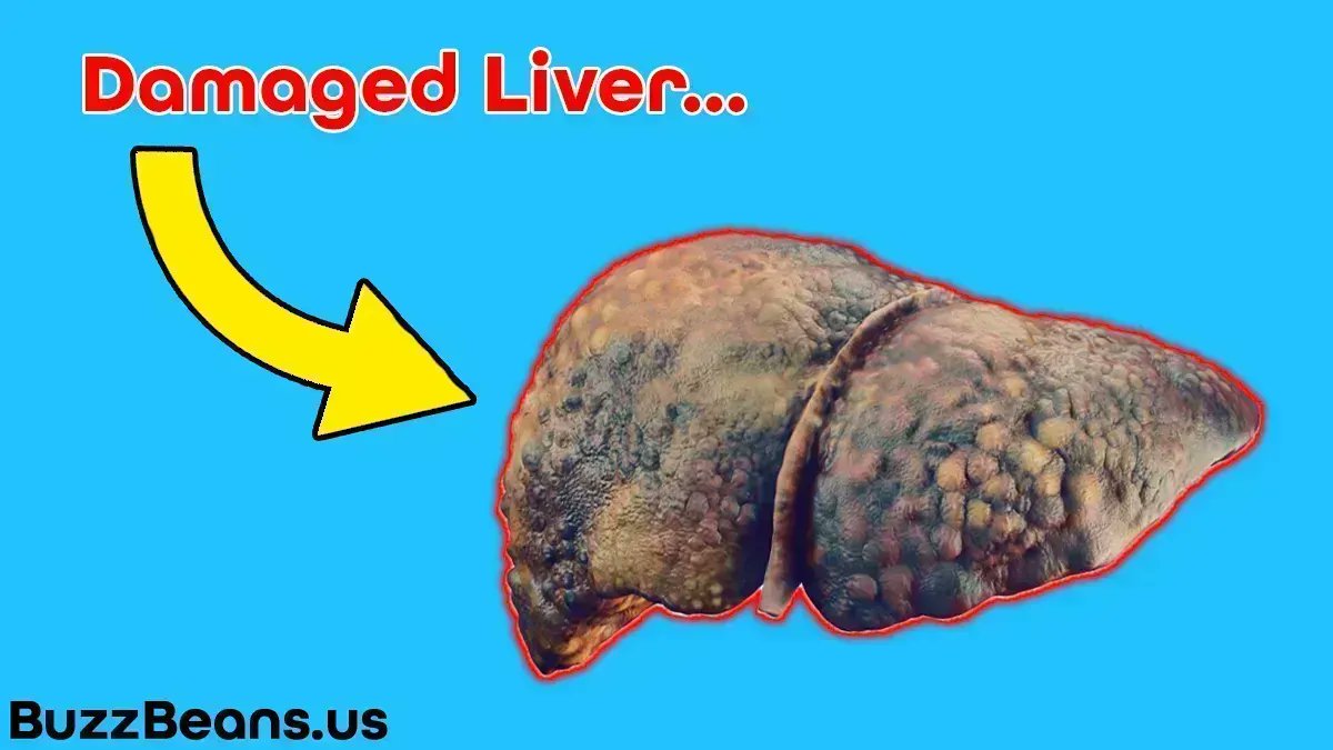 buzzbeans1's tweet image. Research studies suggest that drinking coffee could help reduce liver damage from #alcohol. This study conducted an experiment where over 430k participants with liver damage drank 2 #cupsofcoffee a day. This was linked to a 44% lower risk of developing liver cirrhosis.