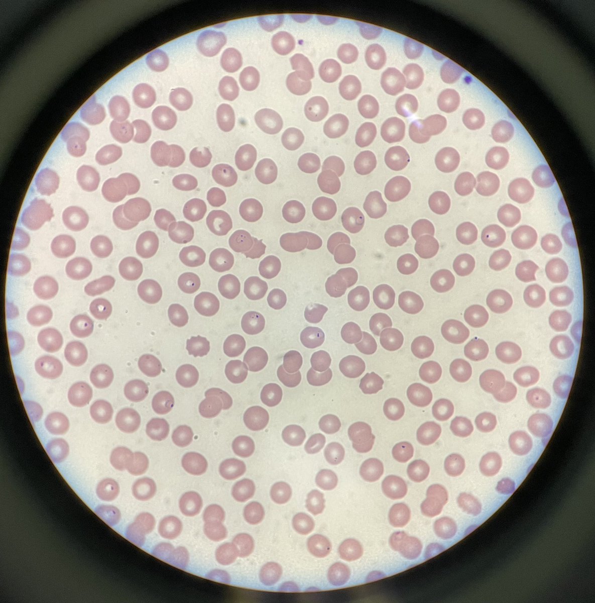 Middle-aged man, returned from Nigeria 2-3 weeks ago, p/w 2-3 days of fevers, emesis, and lethargy. ID consulted at 3am. Labs with significant hemolysis. Peripheral smear shows this with 5% parasitemia. Guess the species? Treatment of choice?