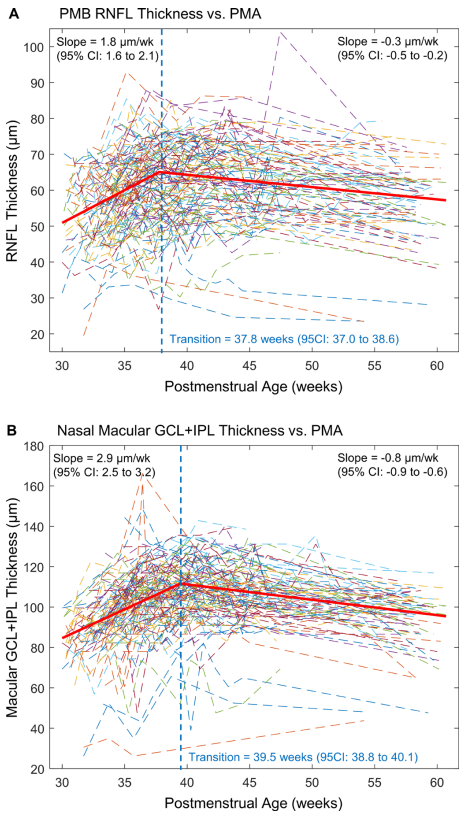 #publication By using a handheld OCT system, we imaged 101 awake preterm infants from 30 to 60 weeks postmenstrual age and found that RNFL thickness increases initially and then decreases after 37.8 weeks.  <a href="/UCSFMedicine/">UCSF School of Medicine</a> <a href="/dukeeyecenter/">Duke Eye Center</a> #ophthalmology #ophthotwitter