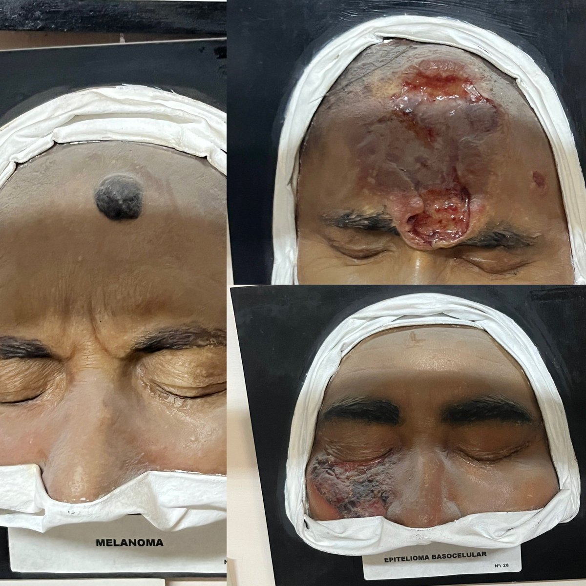 GabrielSalerni's tweet photo. De paso en la Facultad de Ciencias Médicas de la UNR @csmedunr  me encuentro con los antiguos “moulages” o figuras de cera que se utilizaban para la enseñanza de la Dermatología. Sin dudas, la #dermatoscopia ha cambiado el estadio en el que diagnosticamos los tumores cutáneos https://t.co/2gLtecK1ER