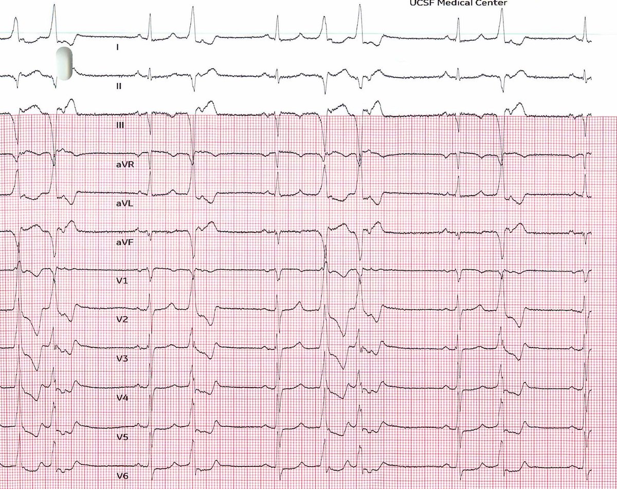 Edward Gerstenfeld (@ed_gerst) on Twitter photo Now that we are all comfortable with LVOT/summit/pap PVCs, have had several of these posteroseptal/crux ones lately that are quite challenging. This took HP RFA from both sides of septum, including 1/2 NS. Nice mapping by <a href="/StaceyHowellMD/">Stacey Howell</a>. Any #EPEEPS have experience with these? Now that we are all comfortable with LVOT/summit/pap PVCs, have had several of these posteroseptal/crux ones lately that are quite challenging. This took HP RFA from both sides of septum, including 1/2 NS. Nice mapping by <a href="/StaceyHowellMD/">Stacey Howell</a>. Any #EPEEPS have experience with these?