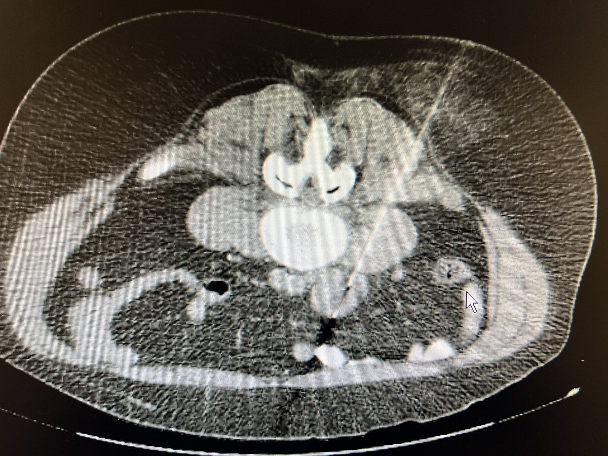 When you biopsy iliac node , not only care about IVC or aorta but also think of ureter. Ureter the “recurrent laryngeal nerve of abdomen”

#radres #radtwitter #futureradres #FOAMrad #radiology #AbdRad #irrad