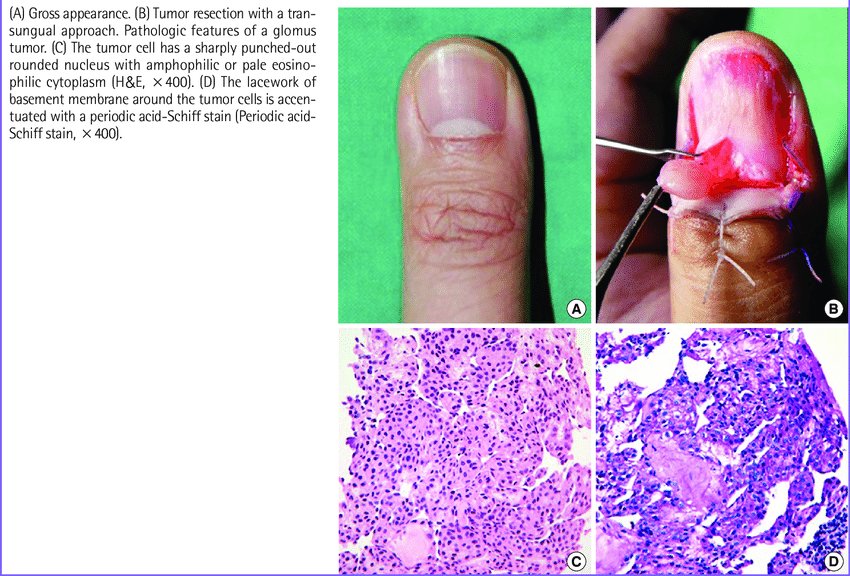 Cells | Free Full-Text | Adult and Pediatric Nail Unit Melanoma:  Epidemiology, Diagnosis, and Treatment