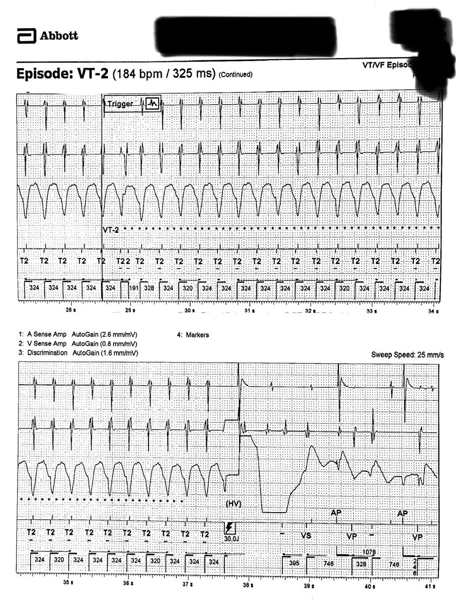 65 y/o with iCM, with several shocks💥⚡️.  What do we learn from these egms? 🕵️‍♀️🤔 #Cardiotweeter #Epeeps