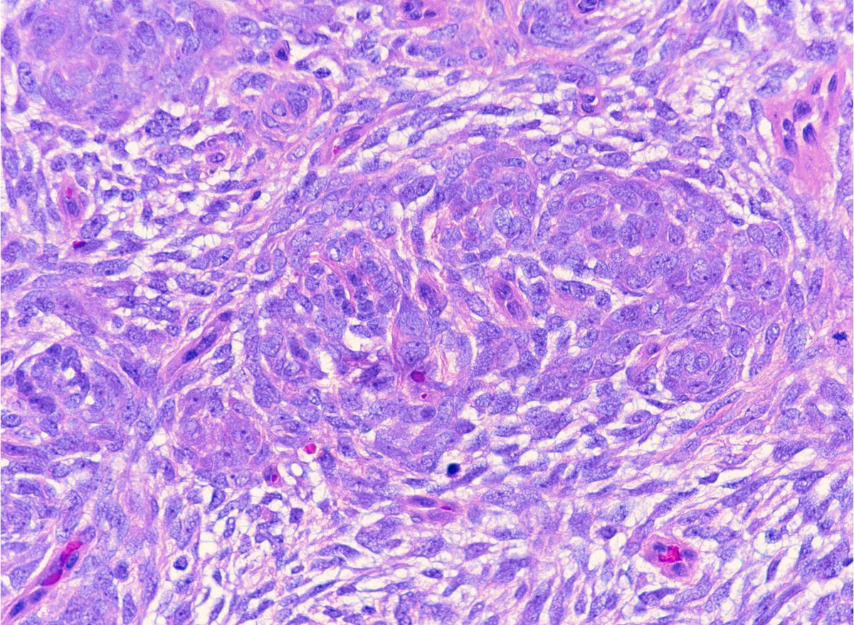 Epithelioid cell clusters can be a helpful feature in this translocation-driven sarcoma, not to be mistaken for synovial sarcoma #BSTpath