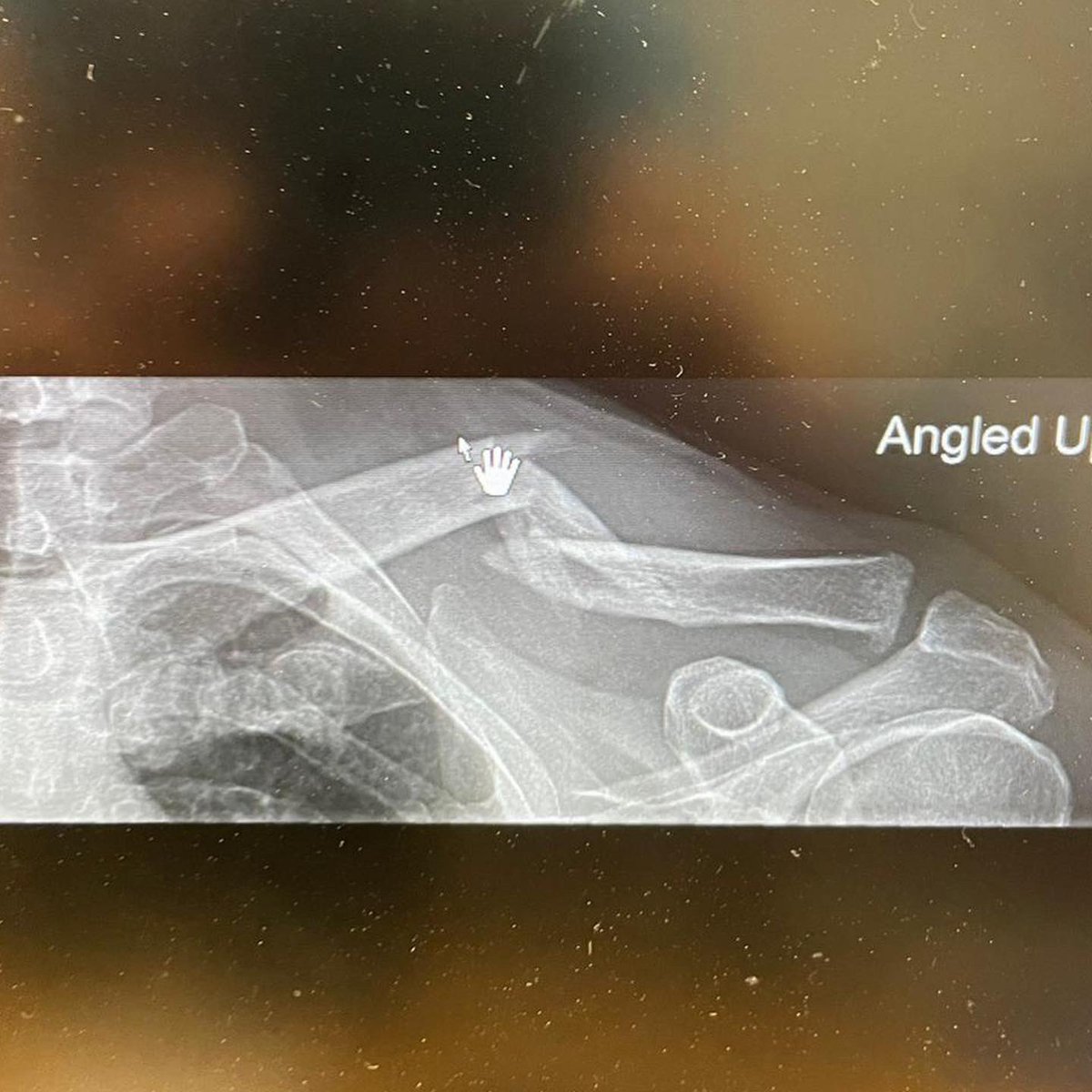 JimRose180's tweet photo. Broke my Clavicle last Thursday snowboarding. I’ve been riding and hitting kickers most of my adult life and broken many bones, but this one slammed proper. I’ve not had a big hit for 15 years, so now to document (for me) my recovery at aged 53 for this one. https://t.co/gNvYggaYT5
