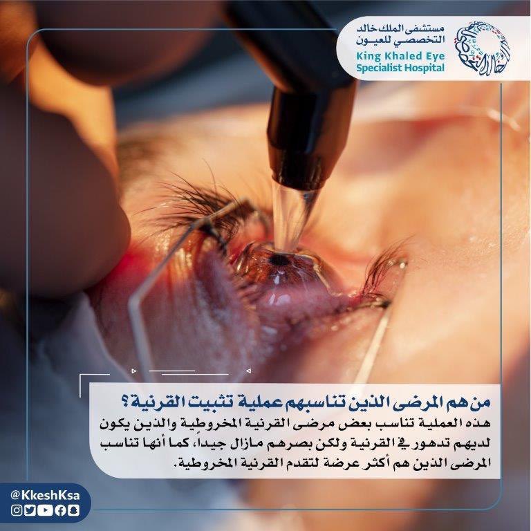 من هم المرضى الذين تناسبهم عملية تثبيت القرنية؟