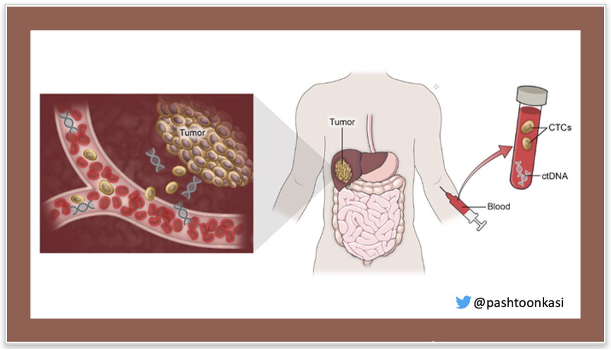 pashtoonkasi's tweet photo. @BenWestphalen @AnnalsofSurgery @OncoAlert @UmbertoMalapel1 @ChristianRolfo #ctDNA not the only kind of #LiquidBiopsies. Other kinds of tumor trash🗑exist in🩸including #CTCs🟣.

Excellent work @AnnalsofSurgery by my medical school @AKUGlobal alumni @ammar_asrar &amp; neighbor at @nyulangone🗽.

👀@gregorybotta &amp; our group @JCO_ASCO on #ctDNA #GI22👇🏾 #PANCSM https://t.co/hF1uuCGU8l
