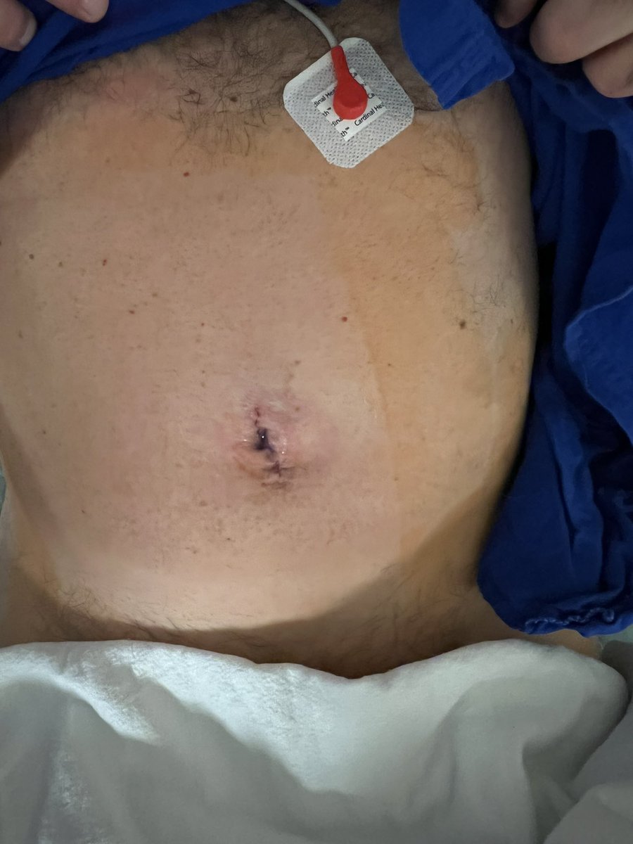 Michael Stifelman (@mdstifelman) on Twitter photo Last case symposium- buccal mucosa ureteroplasty. Patient asking to leave today Thank you <a href="/RoboUroMD/">RoboUroMD</a> <a href="/drpalese/">Dr. Michael A Palese</a> <a href="/MSBillah_md/">M. Shabil Billah</a> <a href="/RoboticsUrology/">Mutahar Ahmed</a> <a href="/NYCRoboticTeam/">Ketan K. Badani MD</a> for making it success and all the program sent their senior residents . <a href="/StanfordUrology/">Stanford Urology</a> <a href="/HarvardURol/">Harvard</a> many others ! Last case symposium- buccal mucosa ureteroplasty. Patient asking to leave today Thank you <a href="/RoboUroMD/">RoboUroMD</a> <a href="/drpalese/">Dr. Michael A Palese</a> <a href="/MSBillah_md/">M. Shabil Billah</a> <a href="/RoboticsUrology/">Mutahar Ahmed</a> <a href="/NYCRoboticTeam/">Ketan K. Badani MD</a> for making it success and all the program sent their senior residents . <a href="/StanfordUrology/">Stanford Urology</a> <a href="/HarvardURol/">Harvard</a> many others !
