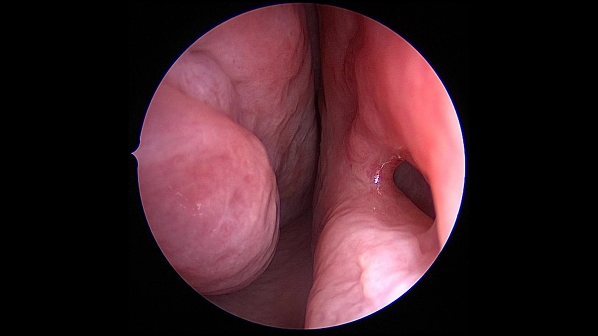 JohnCraigNose's tweet photo. I promise, only 3 more weeks of promo cases for the 3rd annual #HFSNS. Want to see strategies for septal perforations from rhinoplasty and rhinologist perspectives? REGISTER! (Free for nearly everyone, just $20 for attendings!) @henryfordent #metwitter https://t.co/P7bpjjzALr https://t.co/eHu5jHA6cc