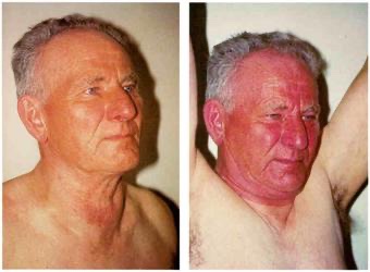 BrownJHM's tweet photo. A 68-year-old man p/w dyspnea, right shoulder pain &amp; facial swelling. When the pt lifted his arms, his face became congested and became dyspneic. What is the clinical sign &amp; diagnosis? #medtwitter (Image: @WildcatEMres) https://t.co/Q8Oo8bOwAt https://t.co/bb4lzm8U6k