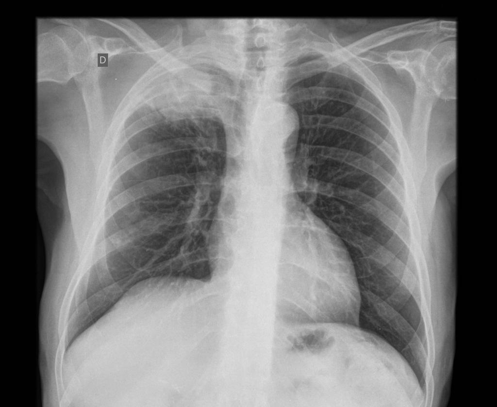 Journal of Brown Hospital Medicine (@brownjhm) on Twitter photo A 68-year-old man p/w dyspnea, right shoulder pain & facial swelling. When the pt lifted his arms, his face became congested and became dyspneic. What is the clinical sign & diagnosis? #medtwitter (Image: <a href="/WildcatEMres/">University of Kentucky Emergency Medicine</a>) tinyurl.com/4afcbuk7 A 68-year-old man p/w dyspnea, right shoulder pain & facial swelling. When the pt lifted his arms, his face became congested and became dyspneic. What is the clinical sign & diagnosis? #medtwitter (Image: <a href="/WildcatEMres/">University of Kentucky Emergency Medicine</a>) tinyurl.com/4afcbuk7