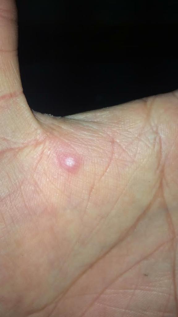 Cpperez2010's tweet photo. A CUIDARSE DE LA #monkeypox ! ESPECIALMENTE LOS MENORES DE 50 AÑOS sin vacuna de la #VIRUELA(1980) COLOCADA! NADA DE #SEXO SIN #PRESERVATIVOS PARA NINGÚN TIPO DE ACTIVIDAD... hasta que lleguen: VACUNA Y ANTIVIRALES! @ACCSI_VIHSIDA @AccionSolidaria @JesusGR3311 @ONUSIDA_VE https://t.co/4cRSzQcCRj
