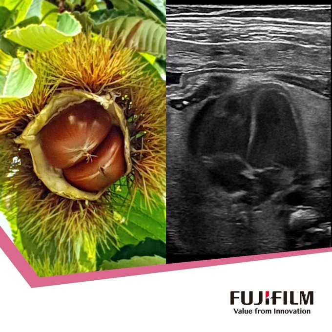 Joao_B's tweet photo. 🌱 Life is a unique journey, where each step is full of significance. Use lightweight probes for all stages of pregnancy - or combine them in CMUT.
@FUJIFILM_HCEMEA #ehealth #mehealth #telemedicine #telehealth #FetalScreening #Pregnancy #nature #Womenshealth #ISUOG #ISUOG22 https://t.co/ji4sB8cDXl