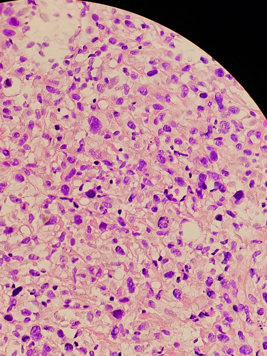 margarita190994's tweet photo. Male,40. Tumor on the thigh, diameter 25 cm.Liposarcoma. #softtissues #pathology https://t.co/hehWQ2uXbu