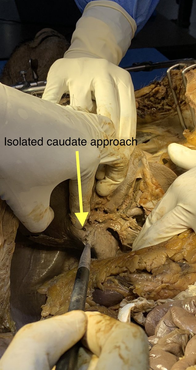 Isolated caudate lobe approach by Dr Venu Gopal Sir