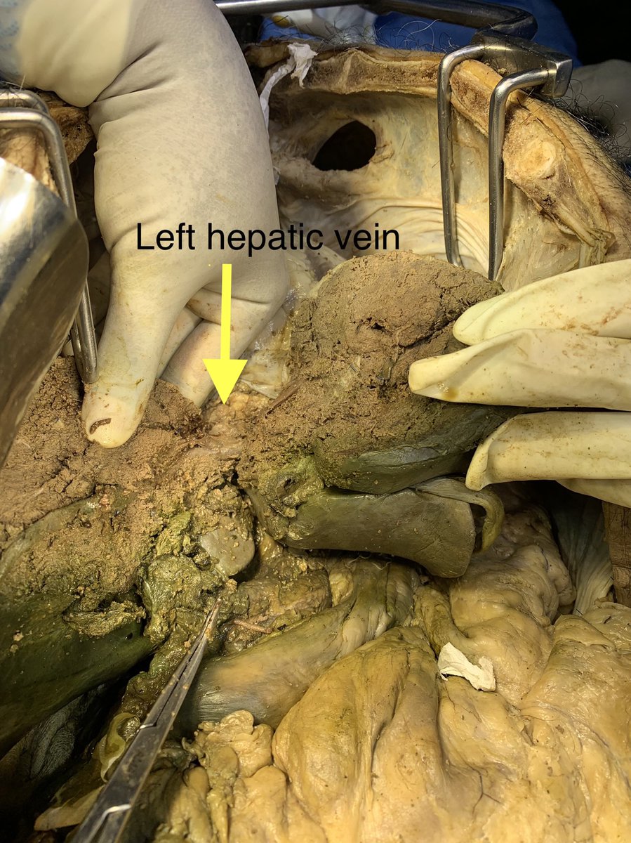 Exposure of left hepatic vein by Dr Madhusudhan sir